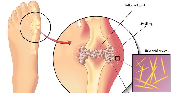 what-causes-increased-level-of-uric-acid-in-the-body